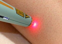 LLLT-Handlaser zur Laserakupunktur